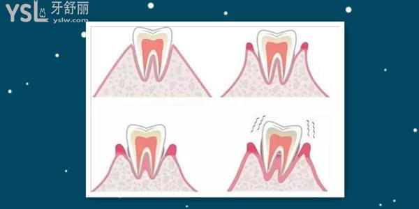 牙床萎缩可以重新恢复吗 看看医生有什么建议.jpg