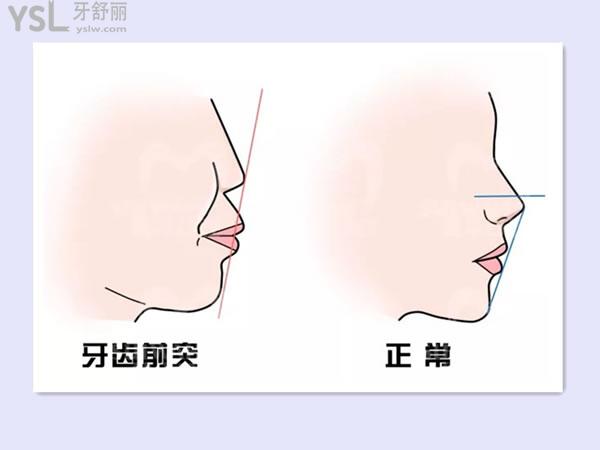 首先要到正规的牙科医院判断是骨性的还是牙性.
