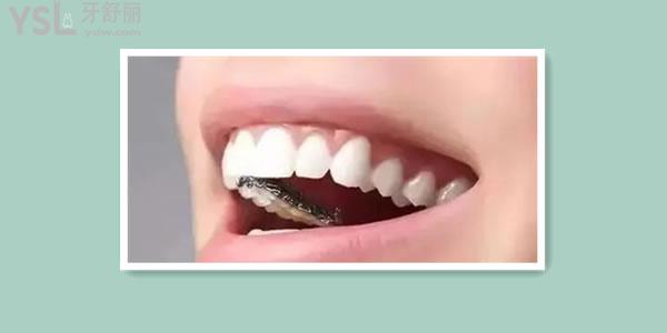 学生牙齿矫正一般选择哪种 纠结隐形和非隐形哪个性价比高