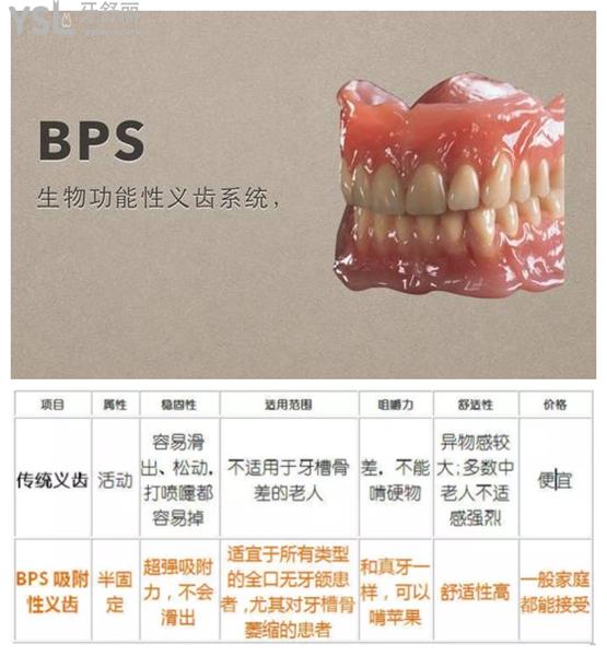 BPS吸附性义齿优势