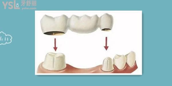 牙齿掉了三种修复方式 伤害小的是活动假牙