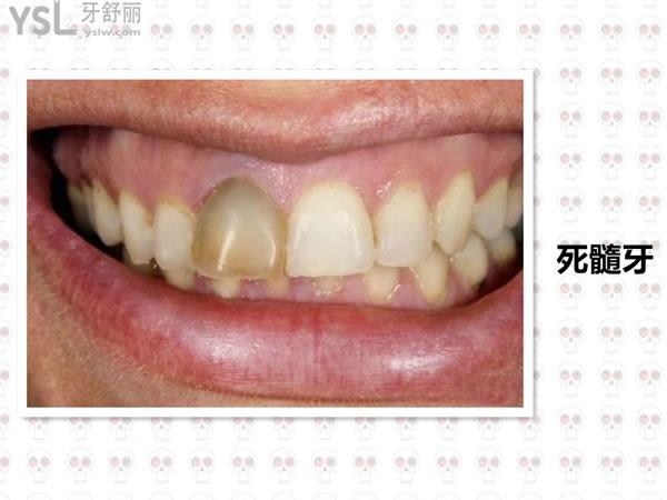 干货必知门牙活髓牙做全瓷牙好还是补牙好?不懂的来看