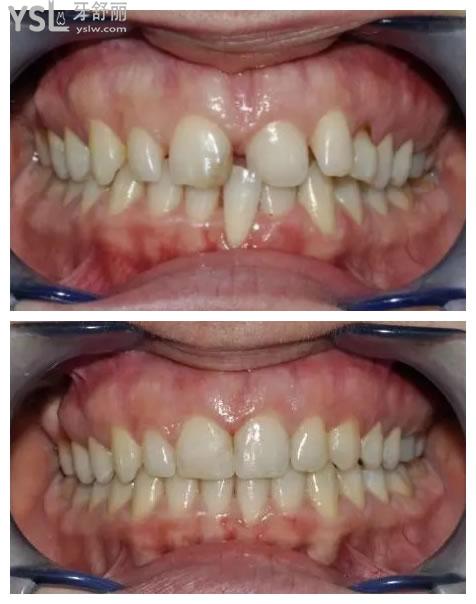 2,牙贴面门牙缝隙大,可以通过瓷贴面来修复,对牙齿的伤害比较小,也