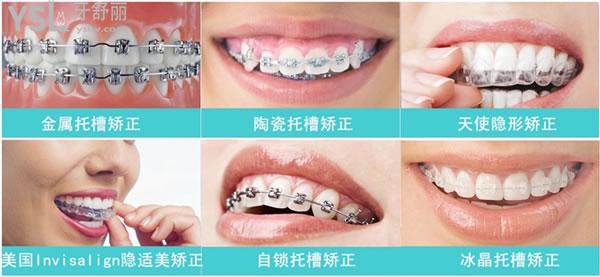 6种牙齿矫正类型