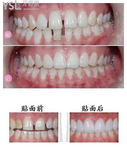 牙贴面改善牙缝对比图