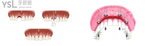 种植牙单颗种植和半口种植图片