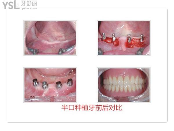 all-on-4半口种植术后图