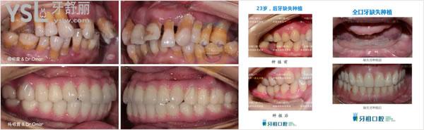 长沙牙祖口腔种植牙＆牙齿修复体验