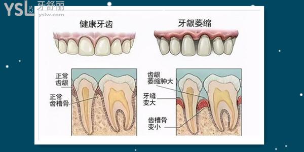 牙槽骨萎缩怎么  又该如何治疗呢.jpg