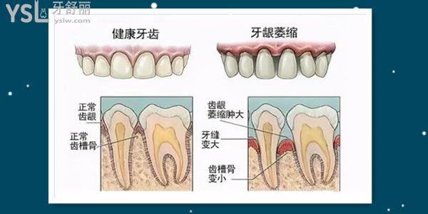 牙槽骨萎缩怎么恢复  又该如何治疗呢.jpg