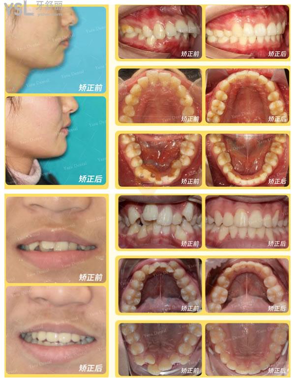 长沙牙祖口腔牙齿矫正体验