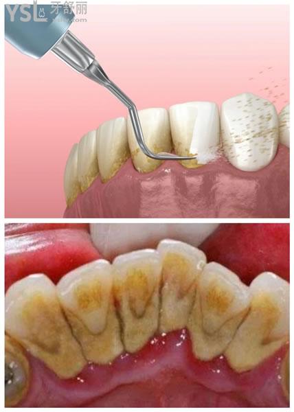 牙菌斑等长期堆积在牙缝之间,久而久之,牙龈红肿,口臭,牙齿松动,经过