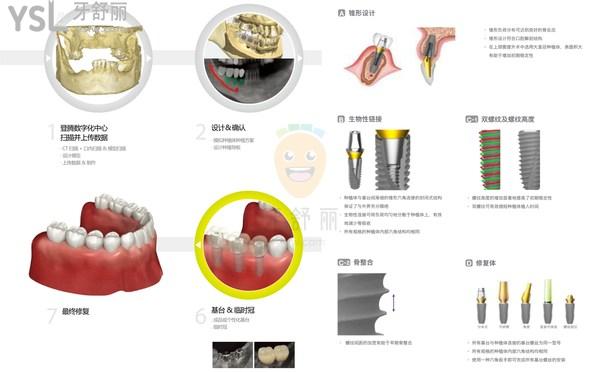 韩国登腾二代是几年产出的，韩国登腾二代种植牙寿命是多少年
