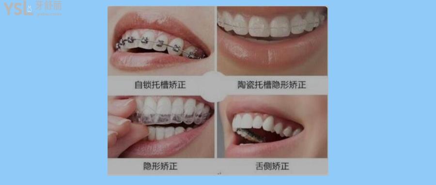 牙套有哪几种类型图片