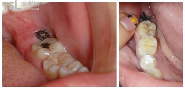 怎么判断是干槽症请注意拔牙后的你是否被干槽症症状入侵