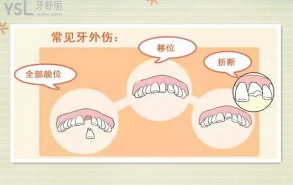 牙外伤的类型