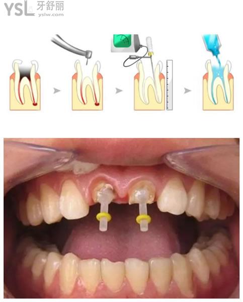 牙齿打桩图片步骤图片