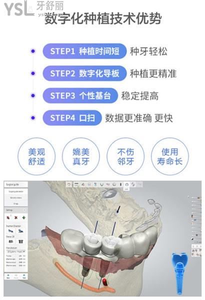 北京科尔口腔种植牙技术优势