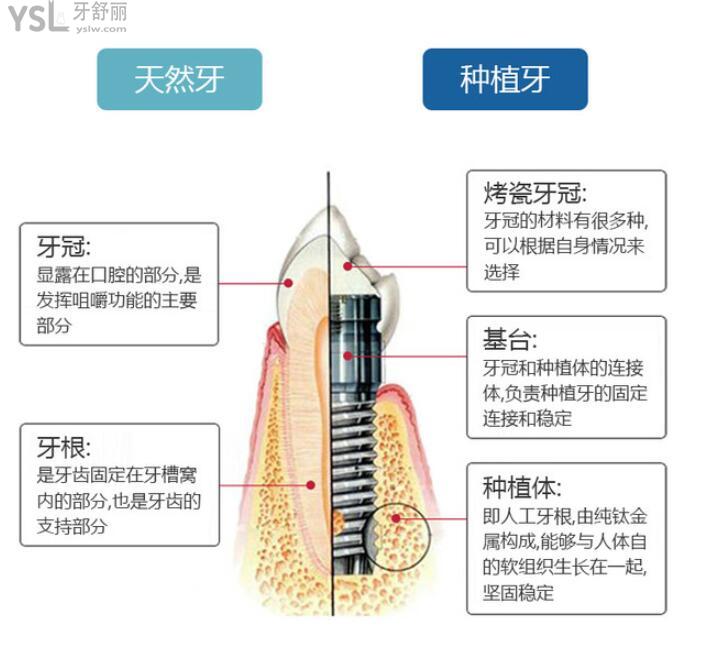 十堰种植牙价格 十堰性价比高的口腔