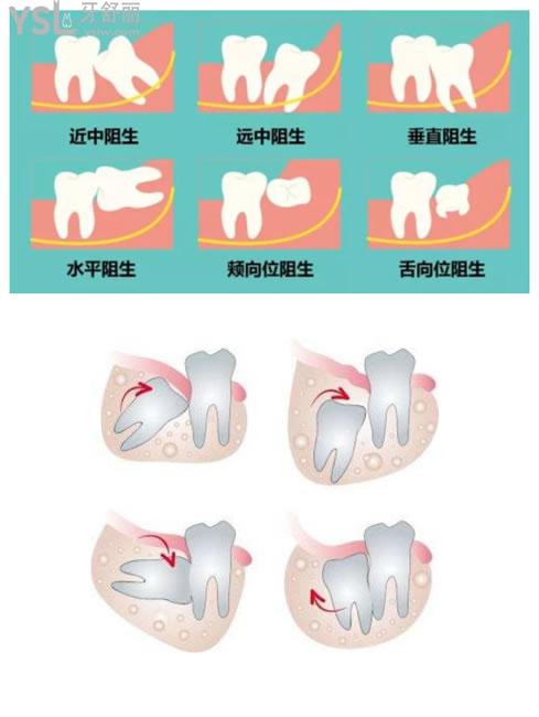 阻生齿类型图片