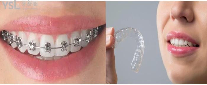 隐形牙套和传统金属牙套对比.jpg