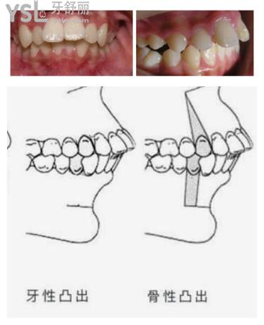 牙槽骨突出矫正方法