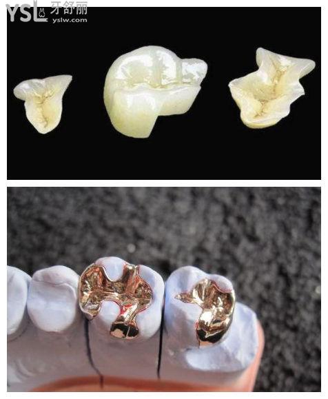 牙齿修复的几种方法微桩是什么意思