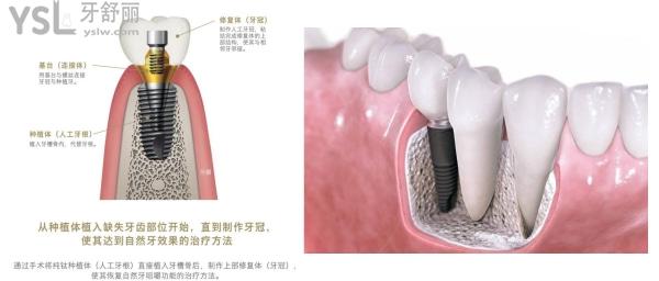 奥齿泰种植牙和登腾种植牙哪个好.jpg