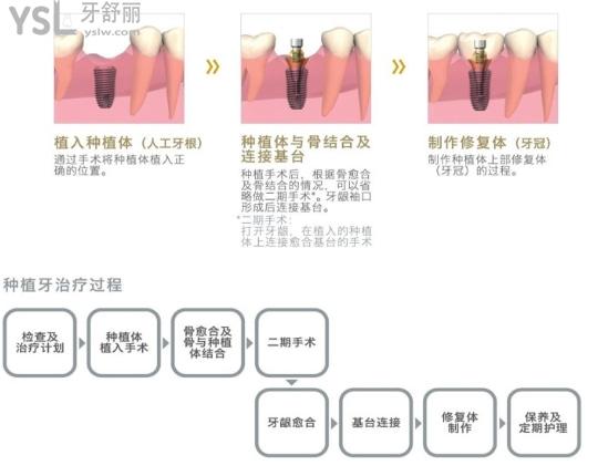 奥齿泰种植牙和登腾种植牙哪个好.jpg