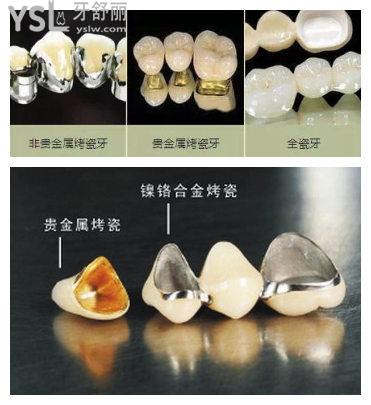 成都烤瓷牙和全瓷牙的价格表