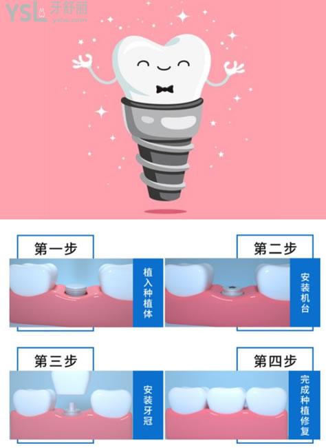 种植牙卡通图片