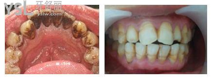成都洗牙一般多少钱