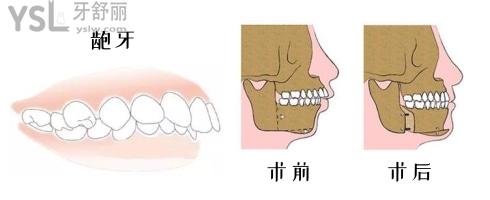 龅牙术前术后对比