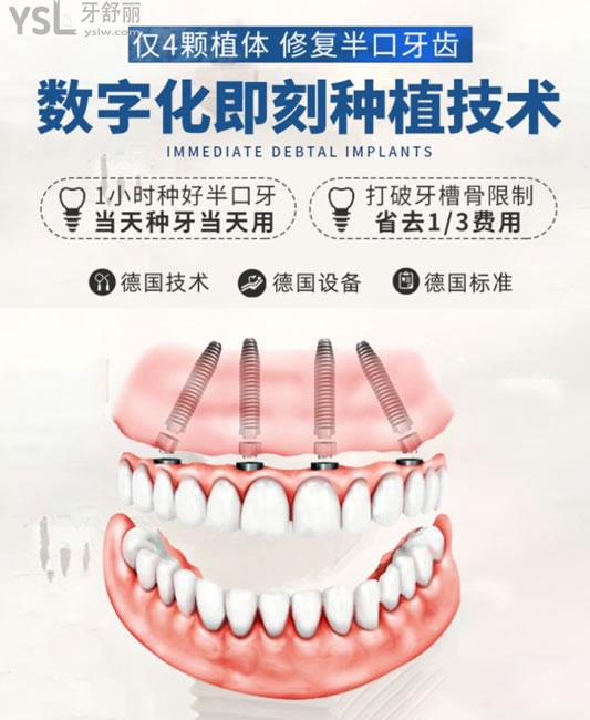 深圳诺德齿科种植牙技术优势