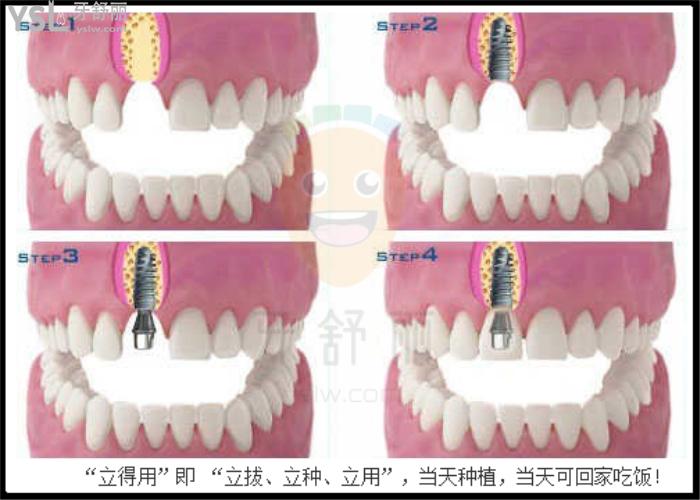 北京中诺口腔医院做种植牙吗？推荐他家的e+立得用种植技术，做的人多好用还不贵！
