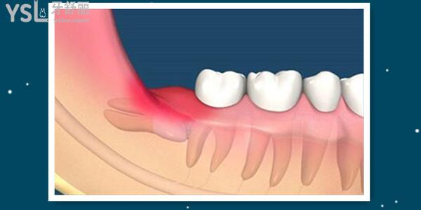 引起牙龈炎主要的病因 如何改善牙龈炎呢.jpg