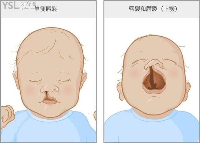 一旦没有正常融合就会形成不同程度的唇腭裂.