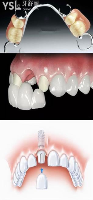 固定义齿、活动义齿、种植牙
