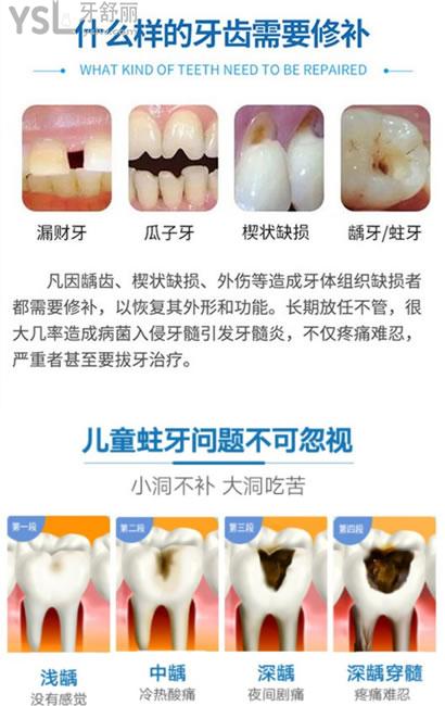什么牙齿需要补