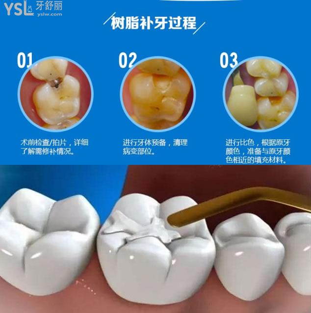 补牙过程图