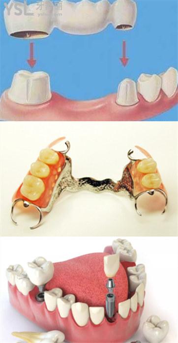 成都锦江区镶牙多少钱