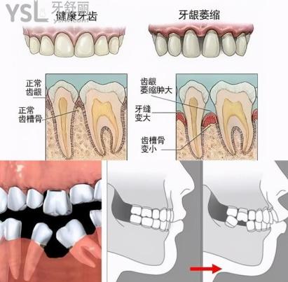 牙槽骨萎缩假牙老掉能做种植牙吗