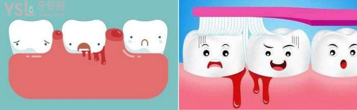 牙龈发炎了怎么办？牙龈发炎能不能自己处理？