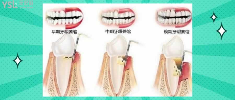 牙龈萎缩图片及症状怎么治疗方法已给到平时记得好好刷牙哦