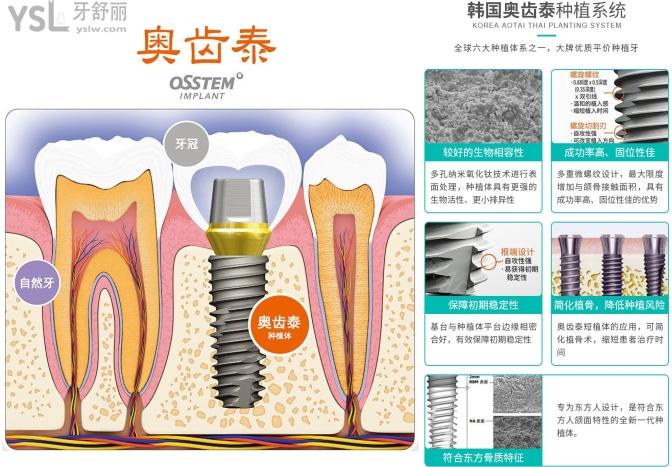 韩国奥齿泰种植牙寿命及价格