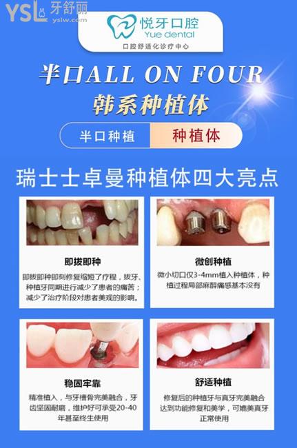 北京悦牙口腔种植牙技术优势