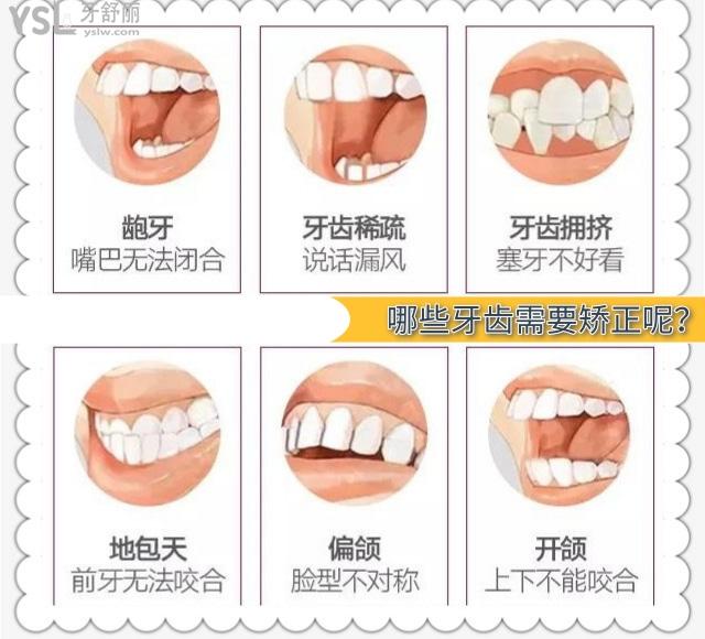 哪些牙齿需要矫正