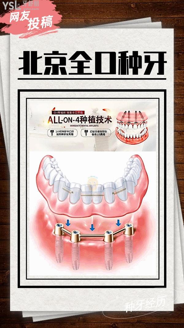 网友投稿-北京全口种植牙<span style=