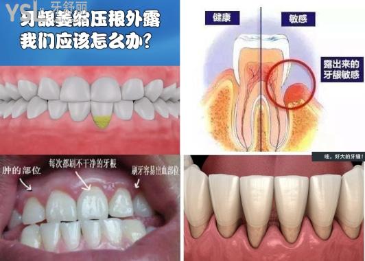 牙龈萎缩,露牙根怎么办,有好方法吗