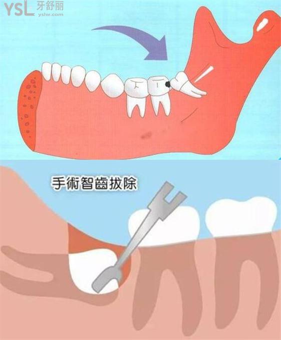 智齿一定要拔吗图片